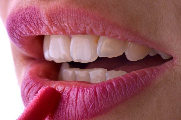Tratamiento de estética dental en BoccaBell